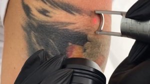 Лазерное удаление татуировки ТИГРА | Пикосекундный лазер работает на 200 %!