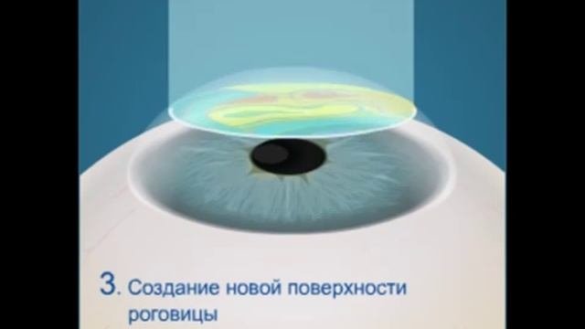Супер Ласик — индивидуализированная лазерная коррекция
