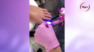 Титановая нить на вросший ноготь