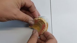 Ацеталовый протез.