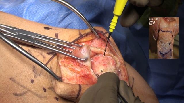 Distal Triceps Repair: Footprint Restoration with Cruciate Bone Tunnels смотреть онлайн