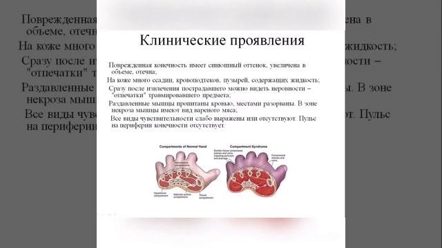 Синдром длительного сдавления