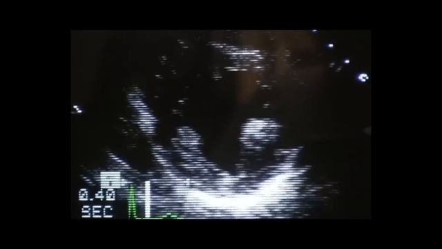 Dr. Dennis Donohue Discusses Stress Tests смотреть онлайн