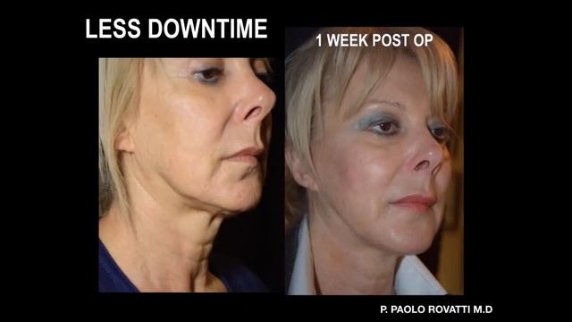 Webinar AccuTite dr Rovatti смотреть онлайн