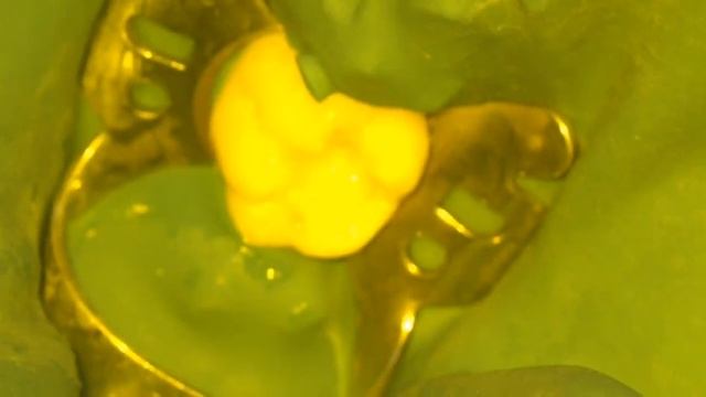 Замена пломбы под микроскопом смотреть онлайн