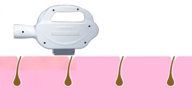 Toplite Xenia SHR e-motion - IPL-SHR-Geräte смотреть онлайн