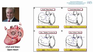 А.Ш. Ревишвили. Гибридное лечение фибрилляции предсердий.