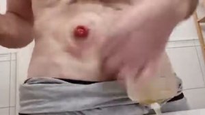 уход за колостомой и илеостомой