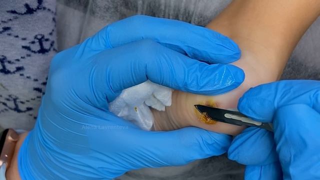 Бородавка у ребенка в 10 лет  Удаление бородавки  Бородавка на ноге что делать  Удалили лазером