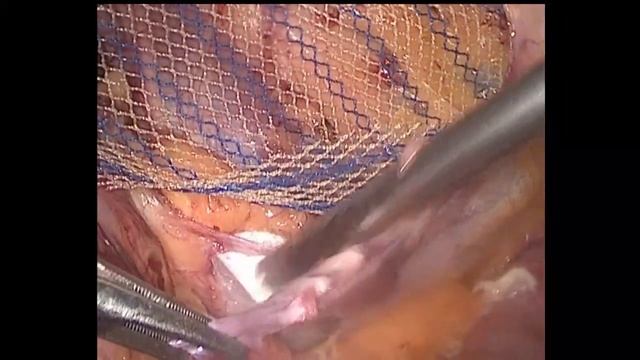 Лапароскопическая герниопластика ТАРР - 10. смотреть онлайн