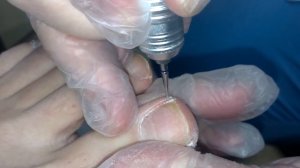 Аппаратный педикюр: закругленный КОНУС для вросших ногтей // HD Freza®