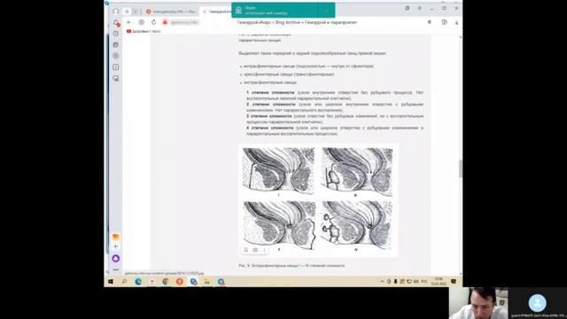 ХРОНИЧЕСКИЙ ПАРАПРОКТИТ. ОСОБЕННОСТИ ХИРУРГИЧЕСКОГО ЛЕЧЕНИЯ.
