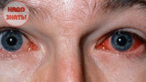 Почему лопаются сосуды в глазах?