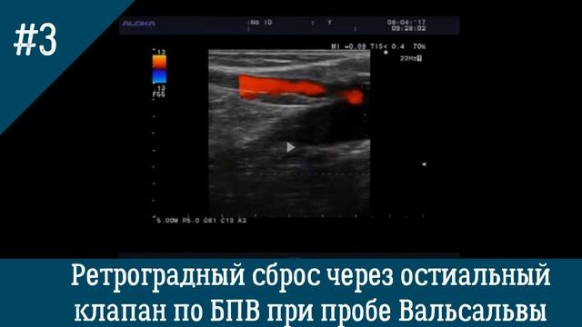 УЗИ вен. Ретроградный сброс через остиальный клапан по БПВ при пробе Вальсальвы.