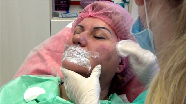 Контурная пластика препаратами Juvederm и Radiesse