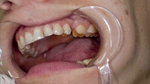 микропротез на вкладках