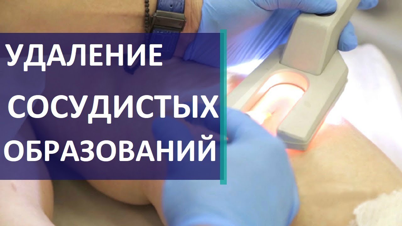 Флебология что это такое ? Врач - флеболог расскажет «Что такое эстетическая флебология».