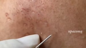 Как Избавиться от Угрей Раз и Навсегда #06 | Как убрать черные точки НАВСЕГДА?