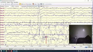 Как научиться расшифровывать ЭЭГ
