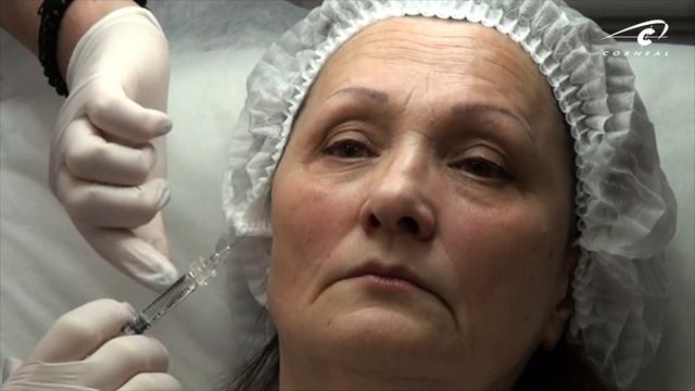Филлеры в носогубные складки. Контурная пластика Princess средняя треть.