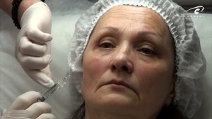 Филлеры в носогубные складки. Контурная пластика Princess средняя треть.