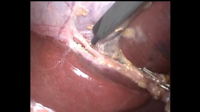 Laparoscopic cholecystectomy. Небруталы хирургируют "голубой пузырек"-22 смотреть онлайн