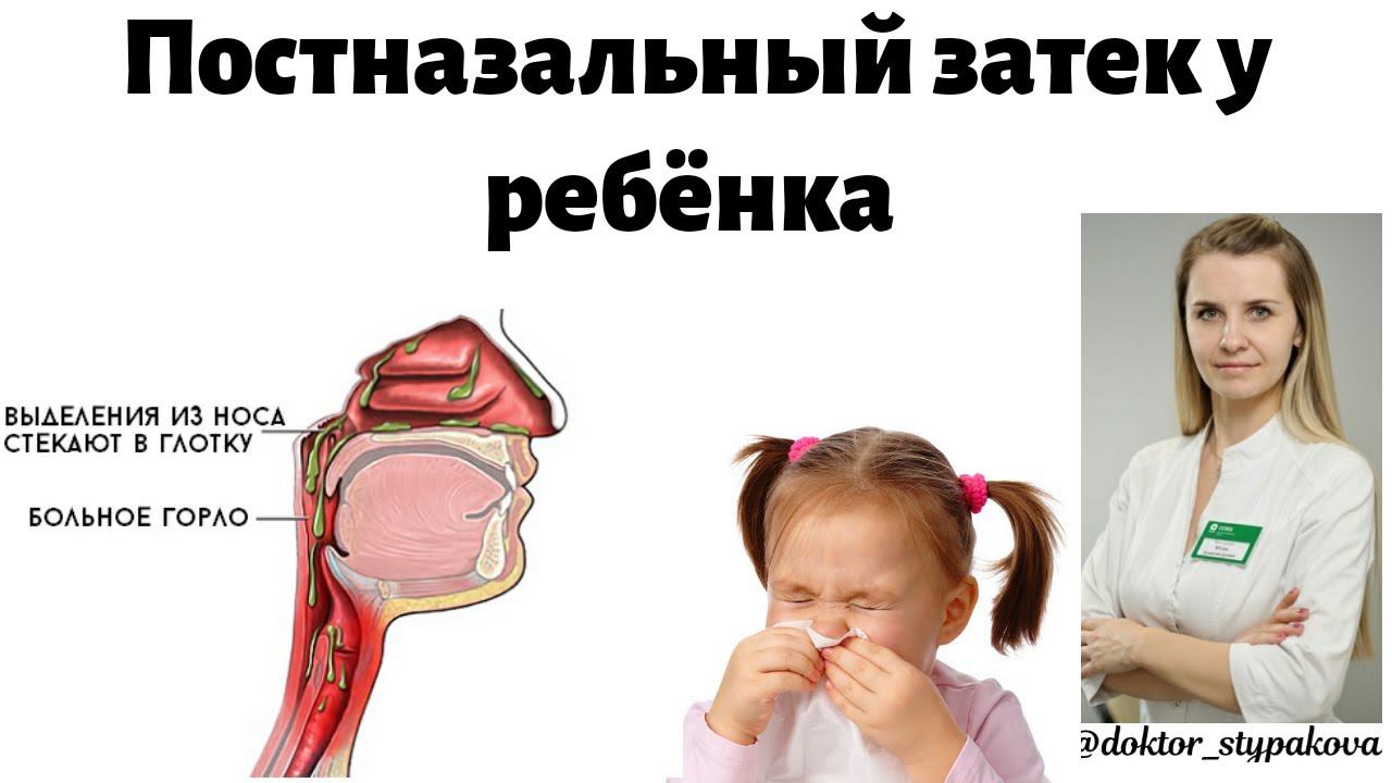 Постназальный затек у детей .Как отличить синдром постназального заката от инфекционного кашля? смотреть онлайн