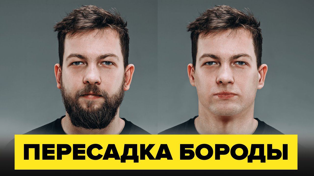 Пересадка бороды: Все, что вам нужно знать