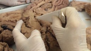 Боковые желудочки головного мозга.