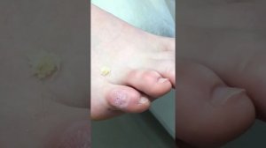 Аппаратный педикюр, обработка мозоли