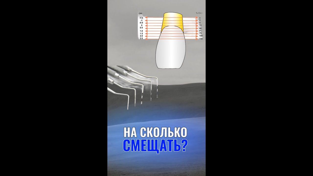 На сколько миллиметров выше ЦЭС должен быть фиксирован коронарно смещенный лоскут ?