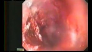 Метод аргоноплазменной коагуляции в остановке желудочно кишечных кровотечений