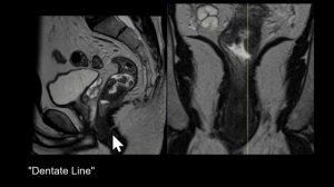 Rectal MRI: Intro to Expert, Rectal Cancer Staging
