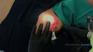 Удаление келоидных рубцов эрбиевым лазером Asclepion MCL31 Dermablate