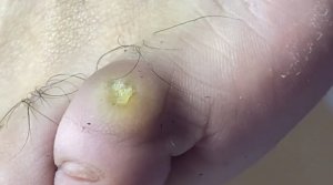 Мозоль на мизинце после лазера?❗️? • Зачистка✅