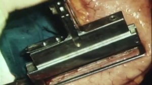 Пластика пищевода желудком, 1987