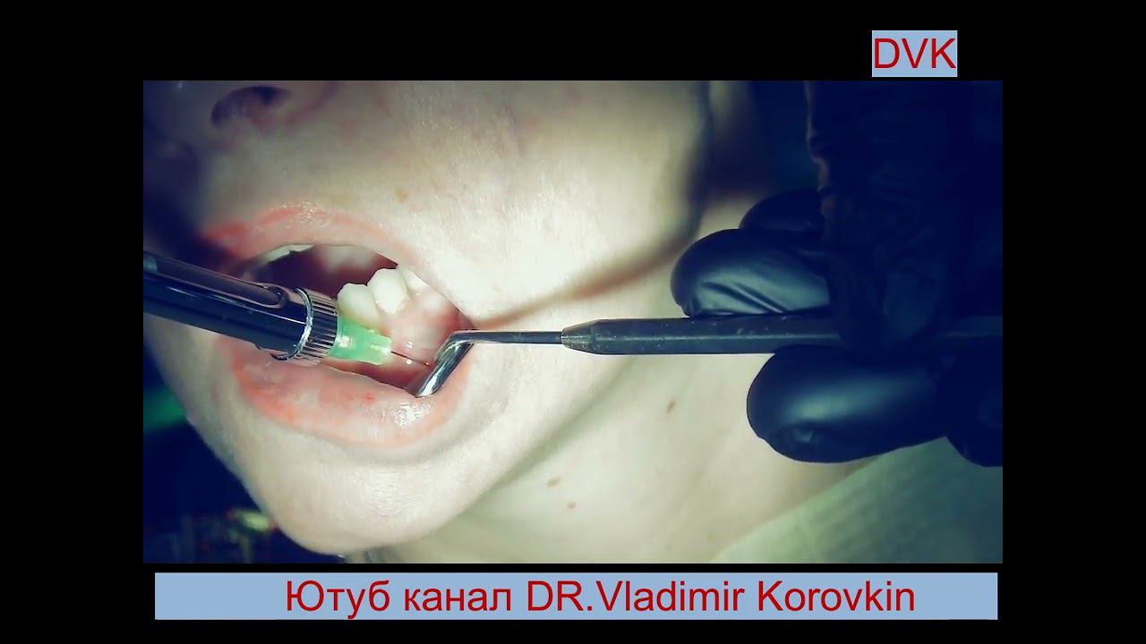 Infiltration anaesthesia for treatment 34 tooth.