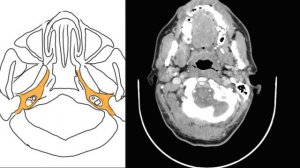 Пространства шеи на КТ