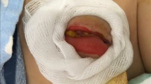 Атрезия ануса Atresia of the anus