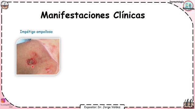 Infeccion bacteriana en la piel: IMPÉTIGO Que es, fisiopatologia y Tratamiento | Piodermitis смотреть онлайн