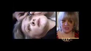 Блефаропластика (пластика век). Пластический хирург Максим Осин