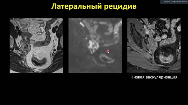 Трофименко И.А Мастер-класс: МР-мониторинг лечения в онкогинекологии смотреть онлайн