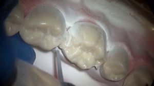 Методика обработки зубов "Four Angle Prep" (преп 4х "углов зуба") от Артура Мартиросяна