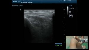 Н.В.Терещенко. УЗИ коленного сустава - демонстрация на пациенте