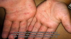 Энтеровирусная инфекция (ECHO-вирусы)