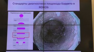 03 Кашин СВ Пищевод Барретта с дисплазией Результаты лечения и длительного наблюдения Гибридная АПК