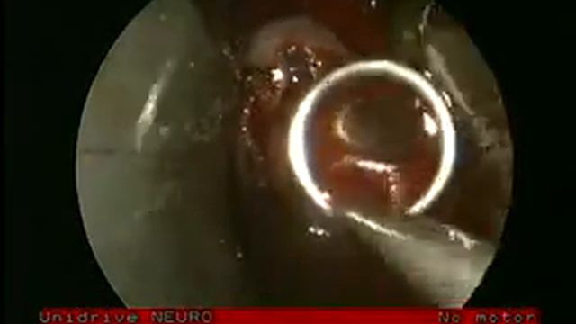 удаление аденомы гф смотреть онлайн