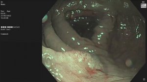 Тубулярная аденома с фокусами дисплазии высокой степени. Полип толстой кишки. Колоноскопия.