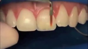 Как реставрируют зуб