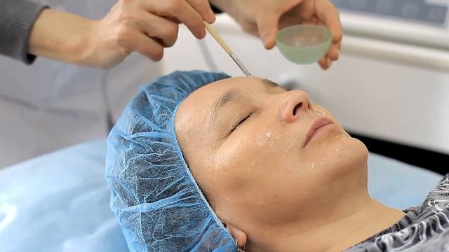 Химические пилинги смотреть онлайн